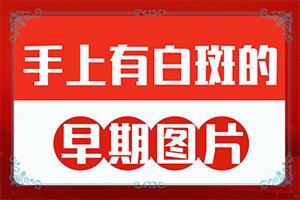 东莞厉害的白癜风医院是哪个