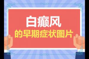 得了白癜风问到东莞那家医看能