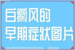 东莞看白癜风较好的医生是谁