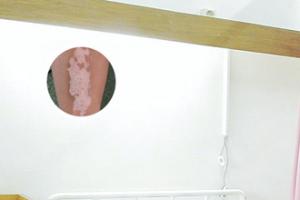 儿童白癫能用些什么药