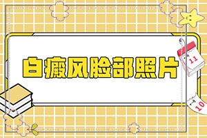 东莞白癜风治疗哪个医院更好