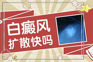 东莞到哪里治疗白癜风较专业