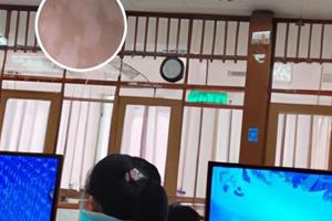 白癜风表皮移植收费明细