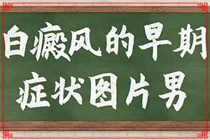 白瘨风东莞哪家医院治疗好