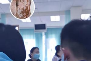 甲泼尼龙会引起血压升高吗