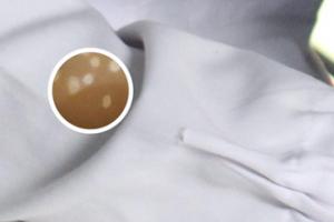白斑不扩散是白颠疯吗