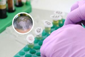 甲泼尼龙片治疗白斑效果好不好