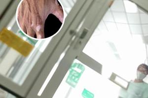 白癜风感冒是什么原因