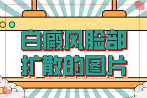 东莞石碣有那些看白癜风医院