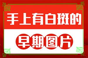 东莞专科医院治疗白癜风需要多少钱