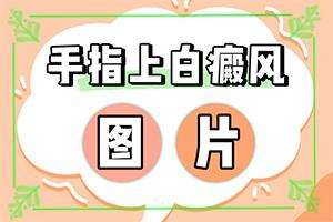 兰州安宁区哪里有治疗白癜风的专科医院