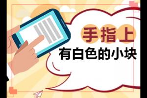 东莞有什么医院能治疗白癜风-手上出现白班是什么原因