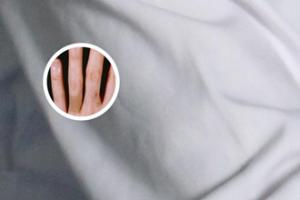 头皮白点癫风可以治好吗图片女
