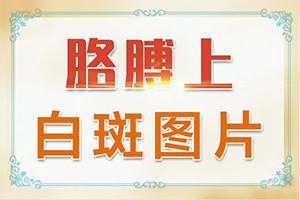 兰州安宁区白癜风治的非常好的医院在哪