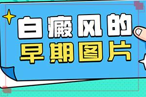 东莞东莞有没有308准分子激光