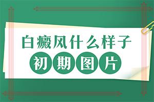 兰州西固区西关十字治疗白癜风医院哪家好